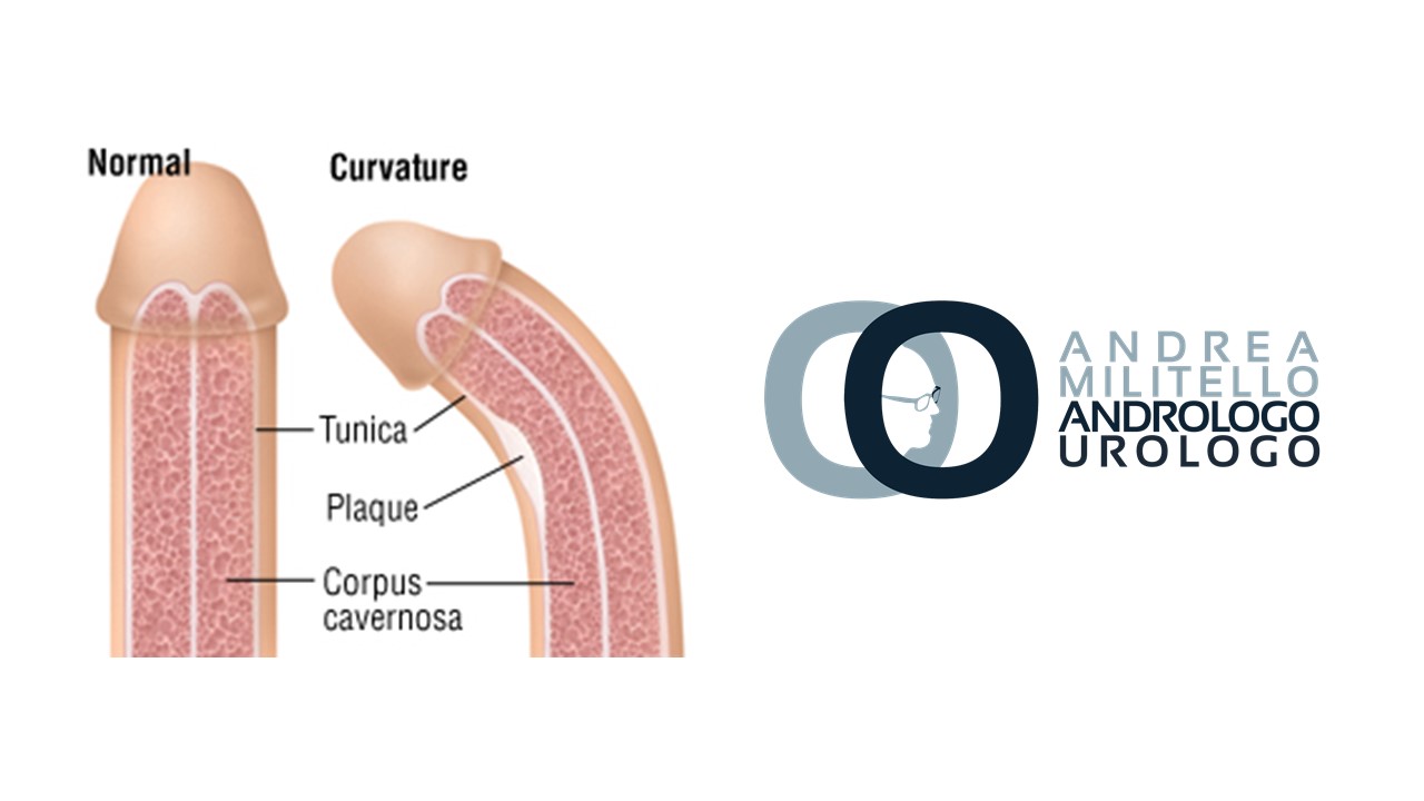 con unerezione, qualcosa interferisce